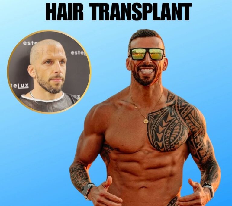 Hair Transplant in Turkey: Cost, What to Expect & Why Patients Choose Istanbul