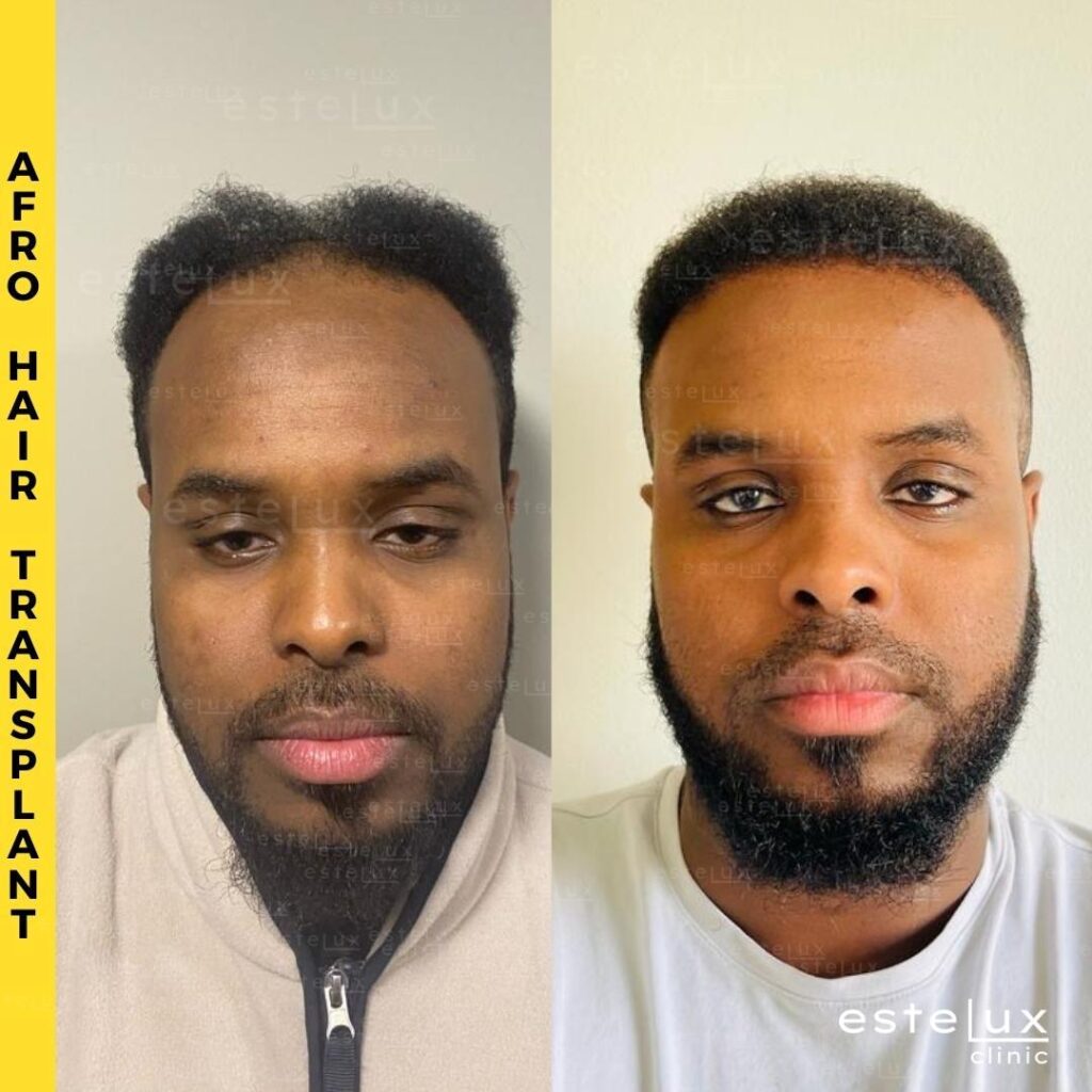 afro hair transplant istanbul before and after 12 months results estelux clinic