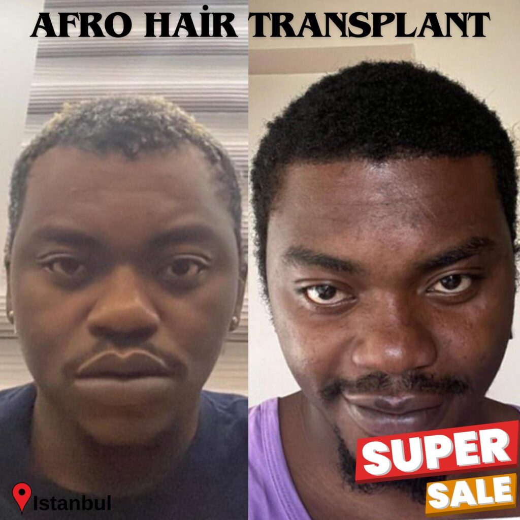 afro hair transplant istanbul before and after 12 months results estelux clinic