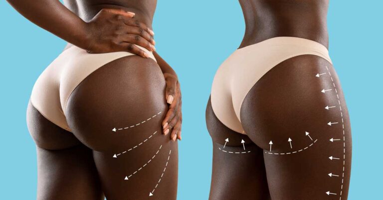 Safe BBL in Turkey: Natural Results with Maximum Safety at Estelux