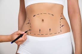 Liposuction in Istanbul - Estelux Clinic