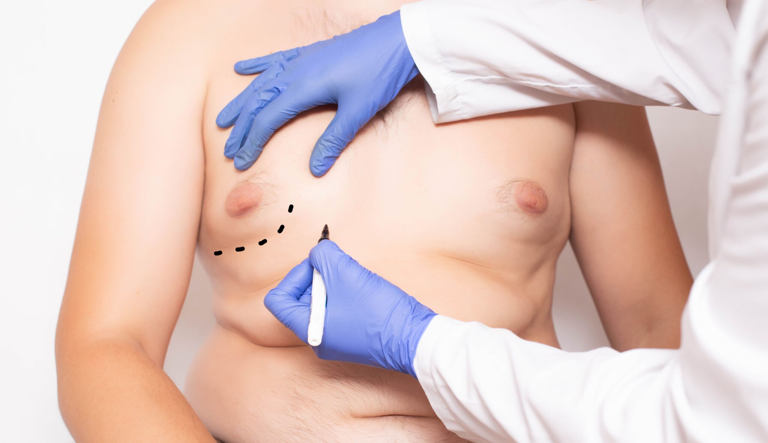 Gynecomastia Surgery in Istanbul - Estelux Clinic