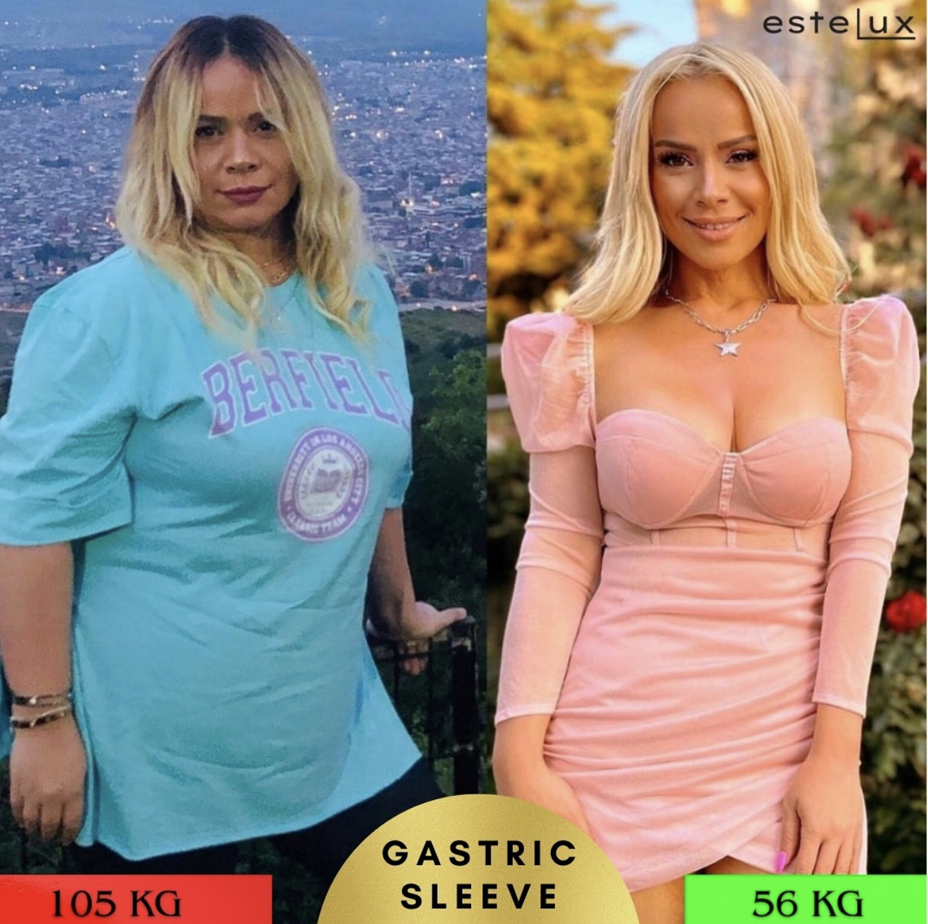 Gastric Sleeve Before After Results - Patient 1