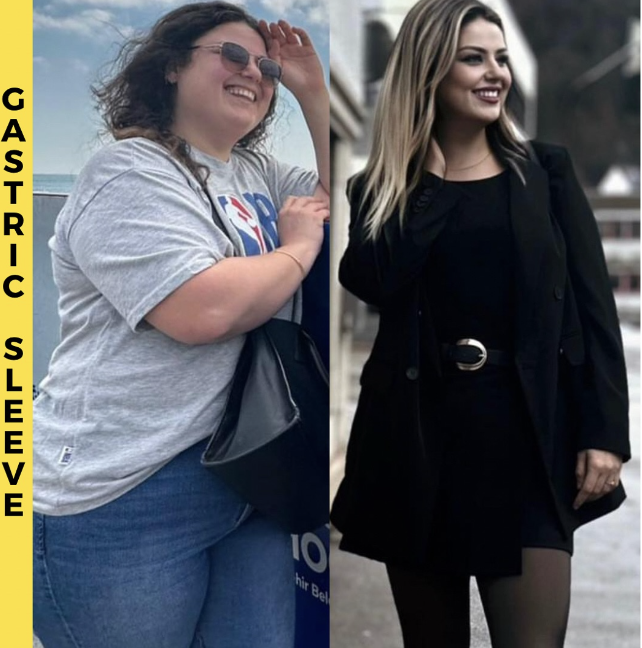 Gastric Sleeve Before After Results - Patient 2