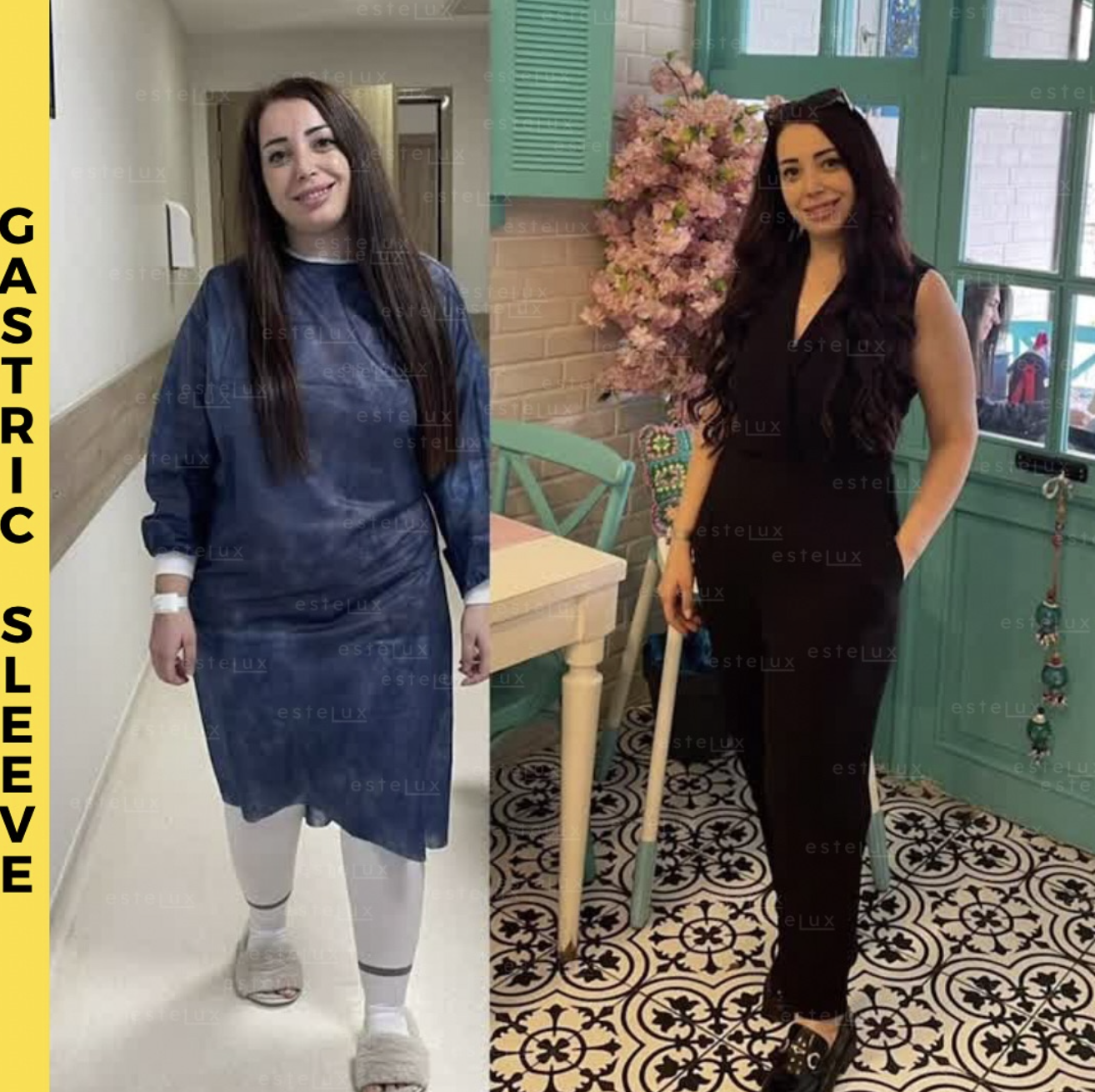 Gastric Sleeve Before After Results - Patient 3
