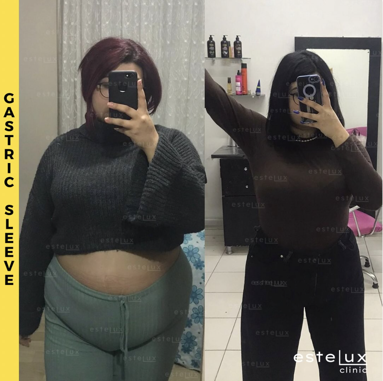 Gastric Sleeve Before After Results - Patient 4
