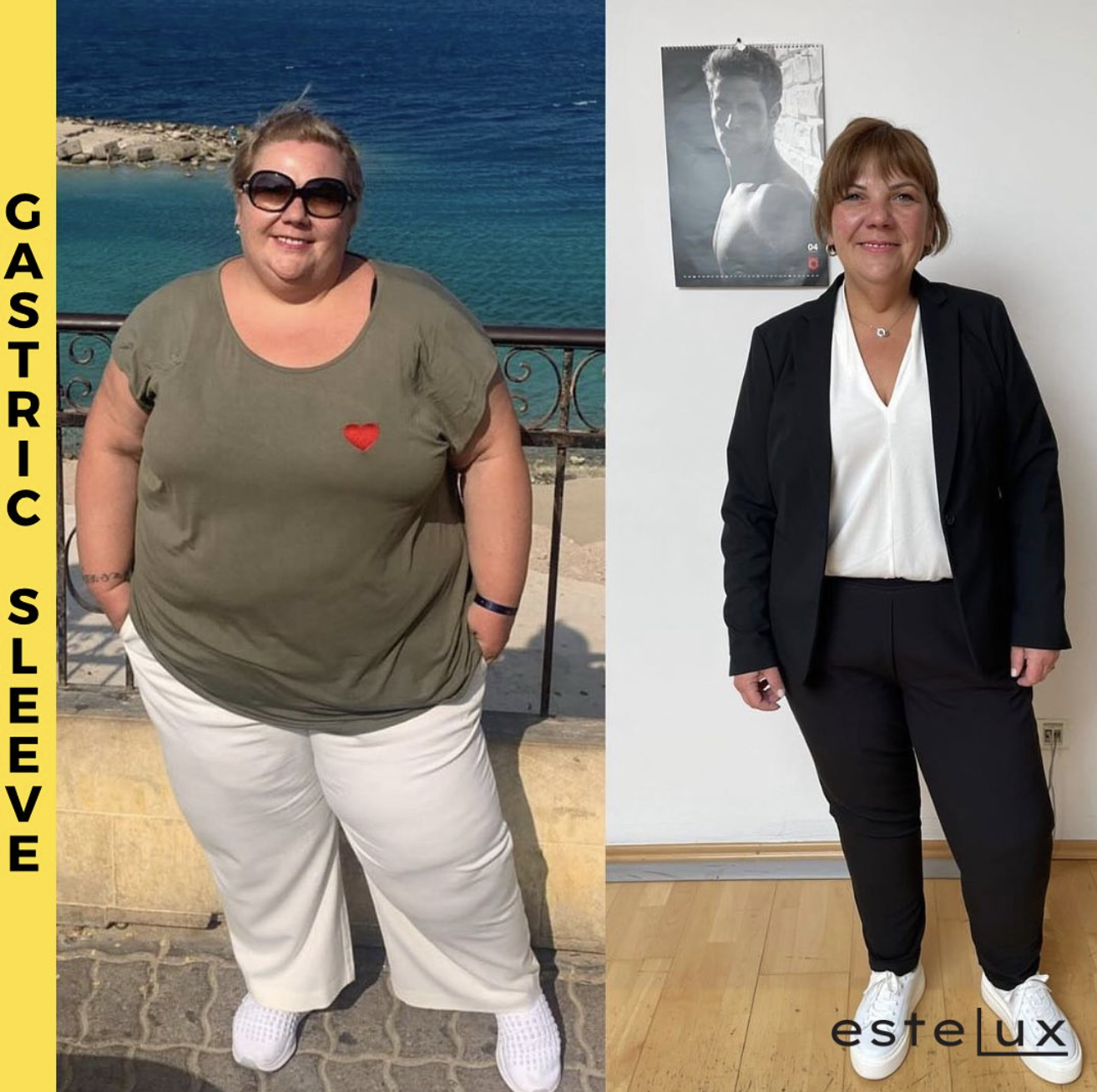 Gastric Sleeve Before After Results - Patient 5