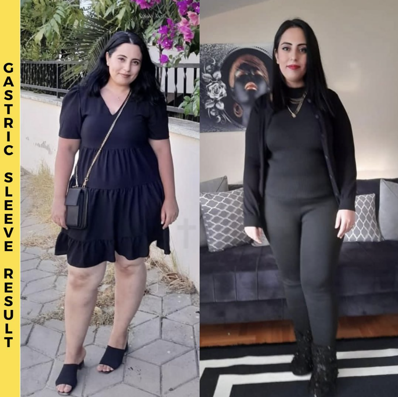 Gastric Sleeve Before After Results - Patient 6