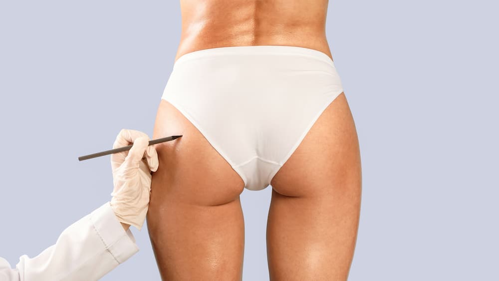 Brazilian Butt Lift BBL in Istanbul - Estelux Clinic