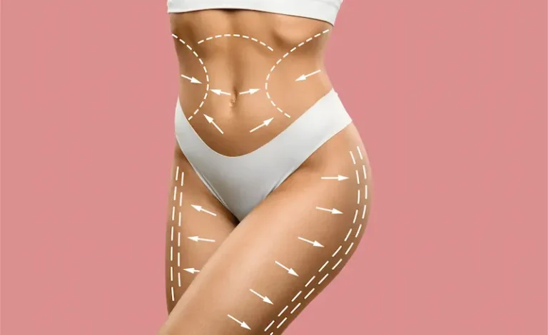 high definition liposuction istanbul estelux