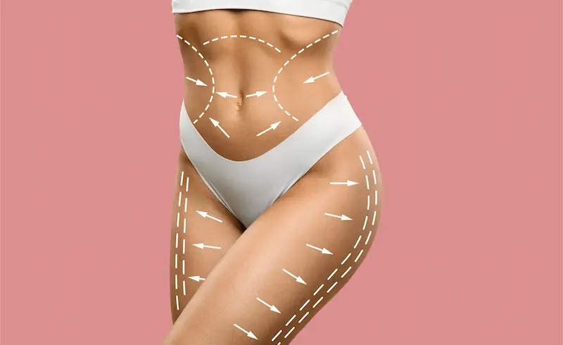 high definition liposuction istanbul estelux