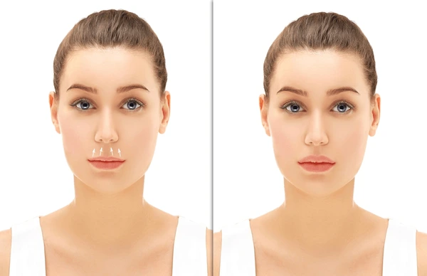 Lip lift surgery results at Estelux Istanbul clinic for UK patients