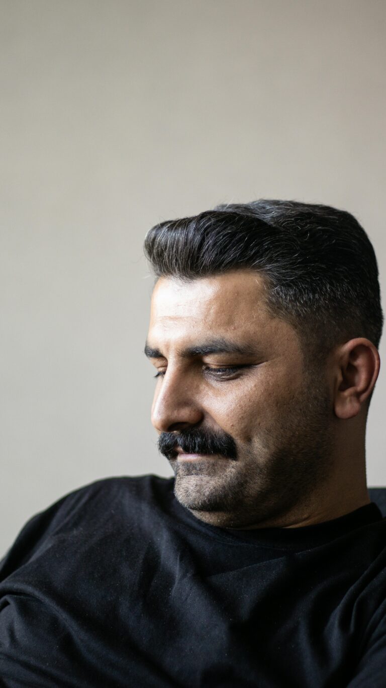 Hair transplant in Istanbul — US patient before and after results at Estelux