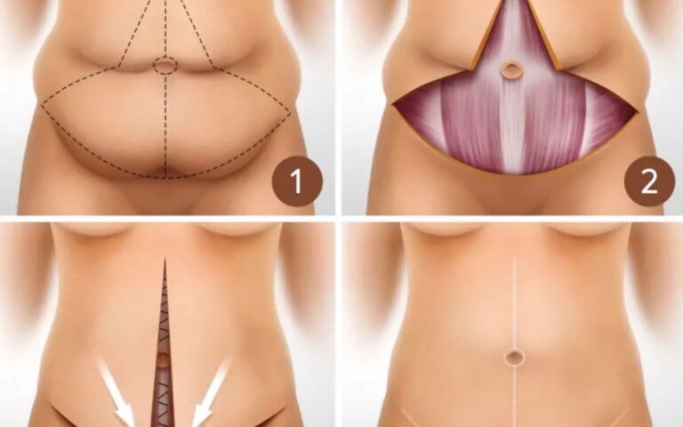 fdl tummy tuck istanbul fleur de lis abdominoplasty estelux clinic op dr ugurlu