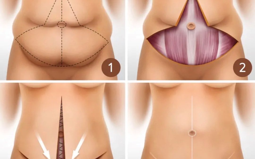 fdl tummy tuck istanbul fleur de lis abdominoplasty estelux clinic op dr ugurlu