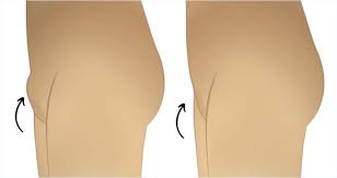 monsplasty istanbul mons pubis lift before after results estelux clinic